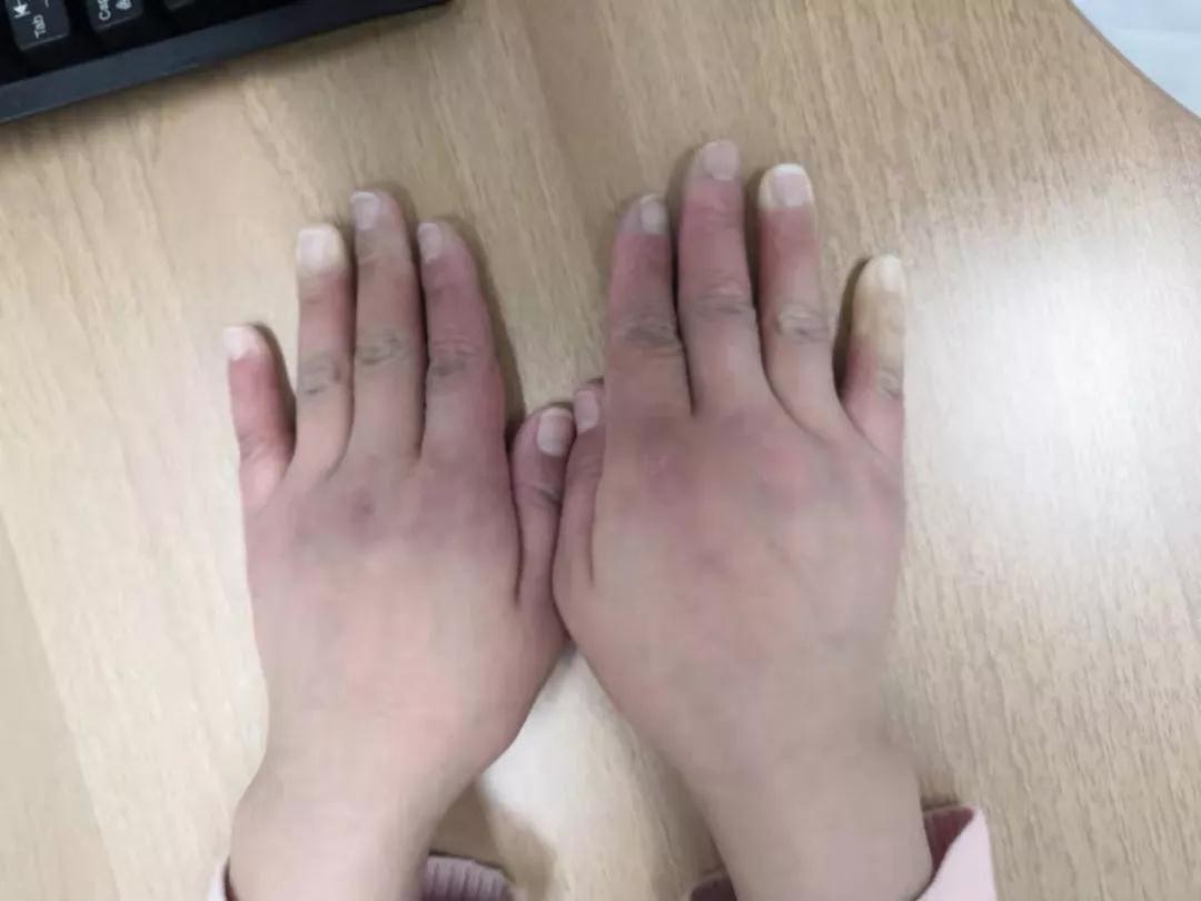 “手指、腳趾發(fā)白、發(fā)紫……”這些“小毛病”千萬別大意
