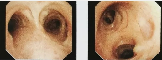 西安國際醫(yī)學中心醫(yī)院成功開展首例鞘管引導(dǎo)的經(jīng)支氣管鏡冷凍肺活檢術(shù)GS-TBLC