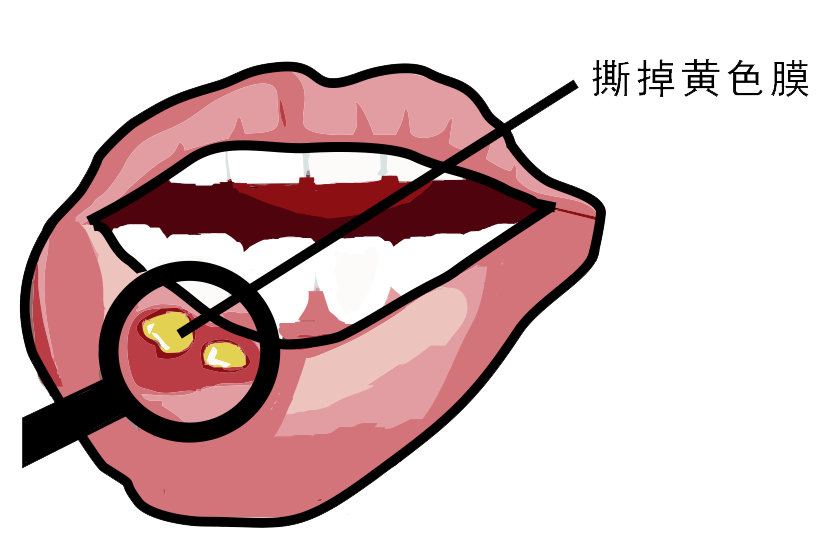 經(jīng)常口腔潰瘍，真的只是缺維生素嗎？