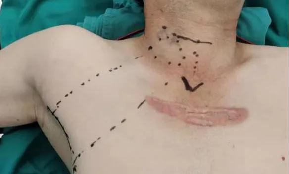 術后傷口可以“隱身”嗎？