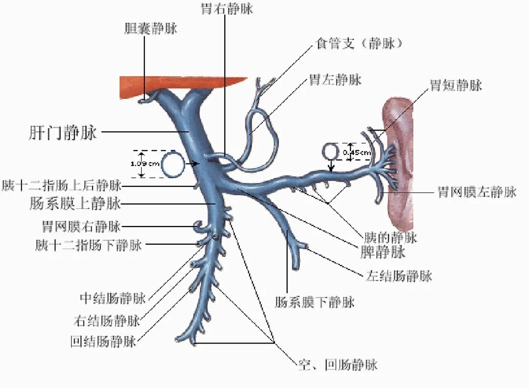 反復(fù)嘔血、黑便怎么辦？TIPS手術(shù)能解決