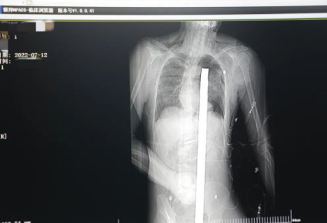 1.2米長(zhǎng)的鋼筋貫穿男子胸腹！情況極度危險(xiǎn)......