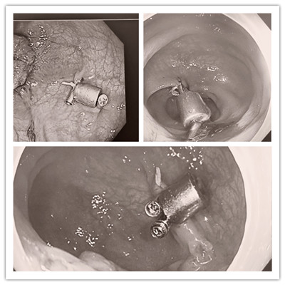 消化病醫(yī)院內(nèi)外科聯(lián)合開展3例“磁環(huán)預(yù)標記輔助腹腔鏡結(jié)、直腸癌根治術(shù)”