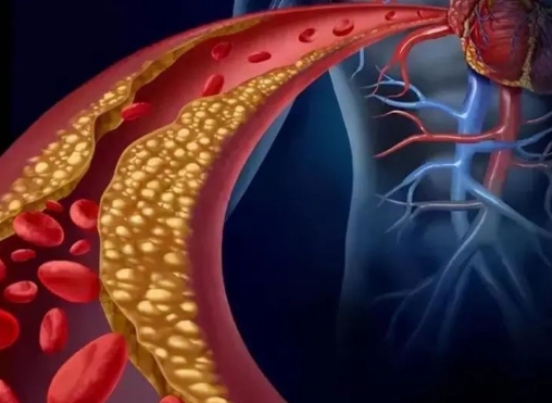 警惕！冠脈支架術(shù)后這些誤區(qū)千萬(wàn)別踩，趕緊收藏！